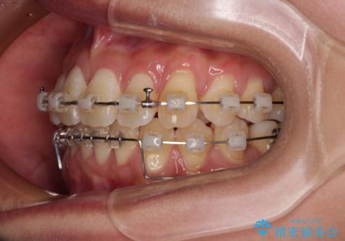 前に飛び出した上顎前歯をスッキリと引っ込める ワイヤー装置での矯正治療の治療中