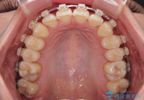 前に飛び出した上顎前歯をスッキリと引っ込める ワイヤー装置での矯正治療の治療中