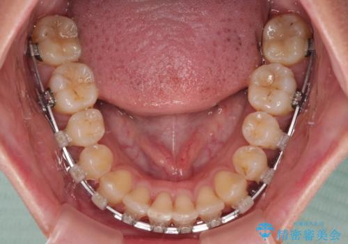 前に飛び出した上顎前歯をスッキリと引っ込める ワイヤー装置での矯正治療の治療中