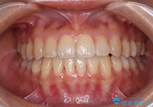 クロスバイトの前歯を改善 ワイヤー装置で楽々矯正治療の症例 治療後