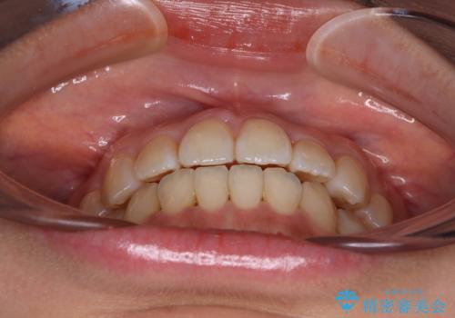 クロスバイトの前歯を改善　ワイヤー装置で楽々矯正治療の治療後
