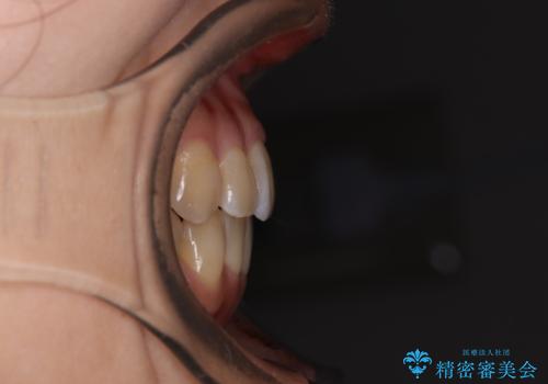 クロスバイトの前歯を改善 ワイヤー装置で楽々矯正治療の治療後