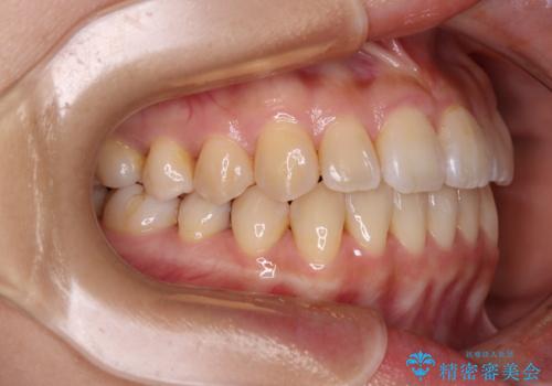 クロスバイトの前歯を改善 ワイヤー装置で楽々矯正治療の治療後