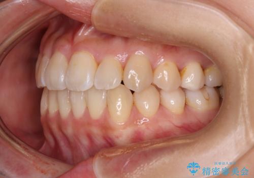 クロスバイトの前歯を改善　ワイヤー装置で楽々矯正治療の治療後