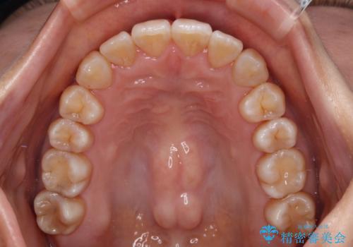 クロスバイトの前歯を改善 ワイヤー装置で楽々矯正治療の治療後