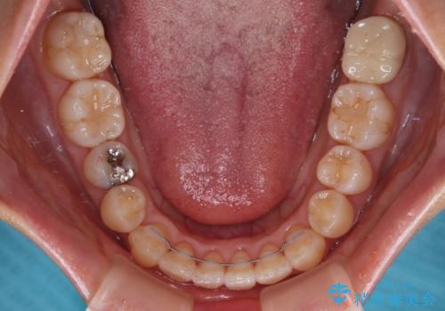 クロスバイトの前歯を改善 ワイヤー装置で楽々矯正治療の治療後