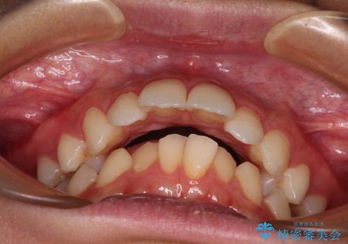 指が入るくらいに隙間のある上下前歯 抜歯矯正で横顔の印象が大きく改善の治療前