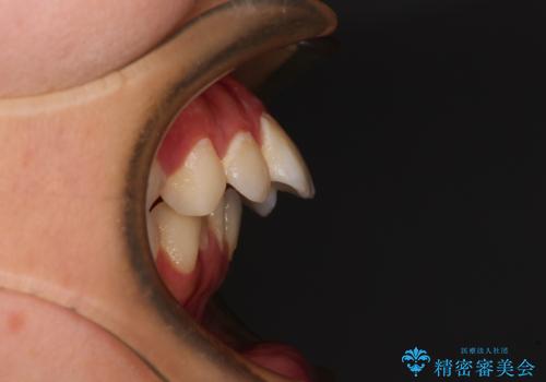 指が入るくらいに隙間のある上下前歯　抜歯矯正で横顔の印象が大きく改善の症例 治療前