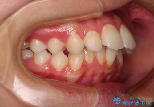 指が入るくらいに隙間のある上下前歯 抜歯矯正で横顔の印象が大きく改善の治療前