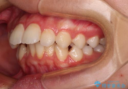 指が入るくらいに隙間のある上下前歯　抜歯矯正で横顔の印象が大きく改善の治療前