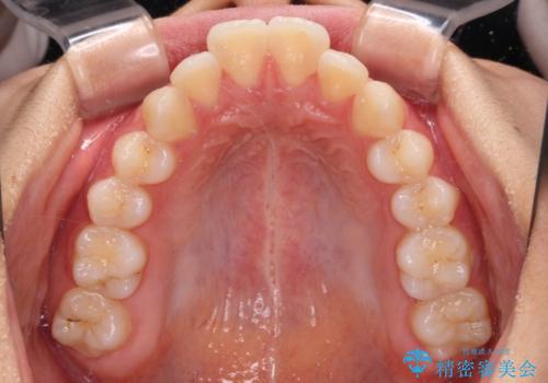 指が入るくらいに隙間のある上下前歯 抜歯矯正で横顔の印象が大きく改善の治療前