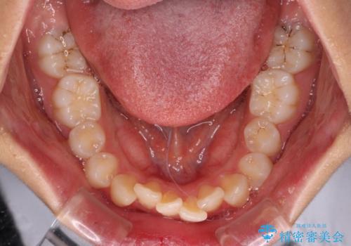 指が入るくらいに隙間のある上下前歯 抜歯矯正で横顔の印象が大きく改善の治療前