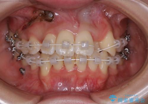 がたつきが強いガチャ歯。埋伏歯抜歯+矯正。すごいところに犬歯が埋まっていたのを抜いてワイヤー矯正治療の治療中