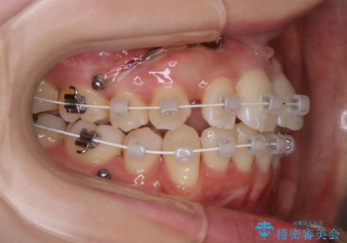 がたつきが強いガチャ歯。埋伏歯抜歯+矯正。すごいところに犬歯が埋まっていたのを抜いてワイヤー矯正治療の治療中