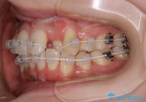 がたつきが強いガチャ歯。埋伏歯抜歯+矯正。すごいところに犬歯が埋まっていたのを抜いてワイヤー矯正治療の治療中