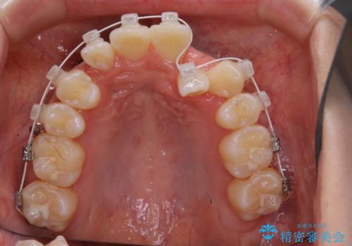 がたつきが強いガチャ歯。埋伏歯抜歯+矯正。すごいところに犬歯が埋まっていたのを抜いてワイヤー矯正治療の治療中
