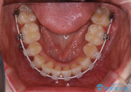 がたつきが強いガチャ歯。埋伏歯抜歯+矯正。すごいところに犬歯が埋まっていたのを抜いてワイヤー矯正治療の治療中