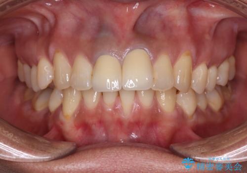 前歯の黒い縁が気になる　オールセラミッククラウンで自然な口元にの治療後