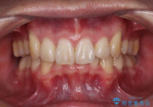八重歯の抜歯矯正　インビザラインを用いて気になる歯並びを改善の症例 治療後