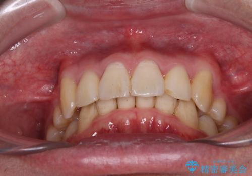 八重歯の抜歯矯正 インビザラインを用いて気になる歯並びを改善の治療後