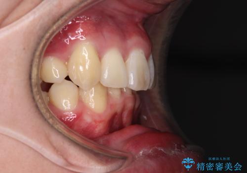 八重歯の抜歯矯正 インビザラインを用いて気になる歯並びを改善の治療後