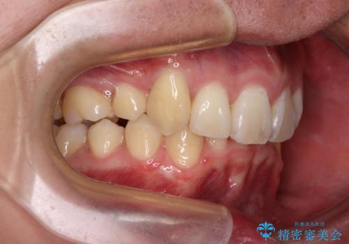 八重歯の抜歯矯正 インビザラインを用いて気になる歯並びを改善の治療後