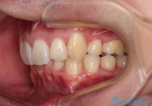 八重歯の抜歯矯正 インビザラインを用いて気になる歯並びを改善の治療後