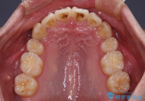 八重歯の抜歯矯正 インビザラインを用いて気になる歯並びを改善の治療後