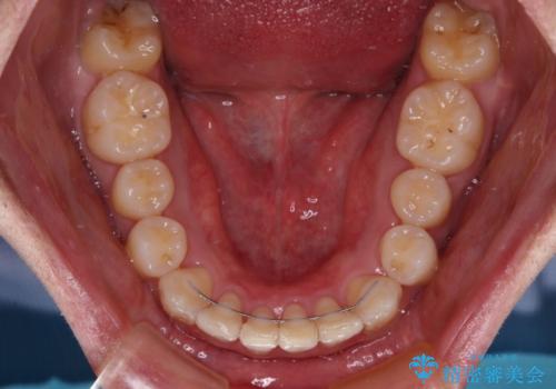 八重歯の抜歯矯正　インビザラインを用いて気になる歯並びを改善の治療後