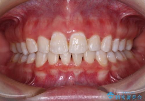 叢生・ディープバイト・突出 ワイヤー装置での抜歯矯正で全てを解決の症例 治療後