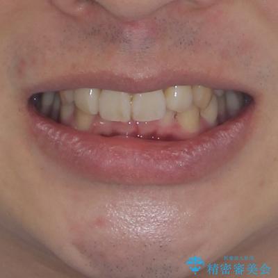 八重歯の抜歯矯正 インビザラインを用いて気になる歯並びを改善の治療後(顔貌)