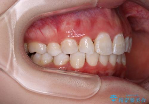 叢生・ディープバイト・突出 ワイヤー装置での抜歯矯正で全てを解決の治療後