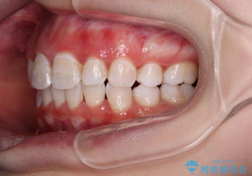 叢生・ディープバイト・突出 ワイヤー装置での抜歯矯正で全てを解決の治療後