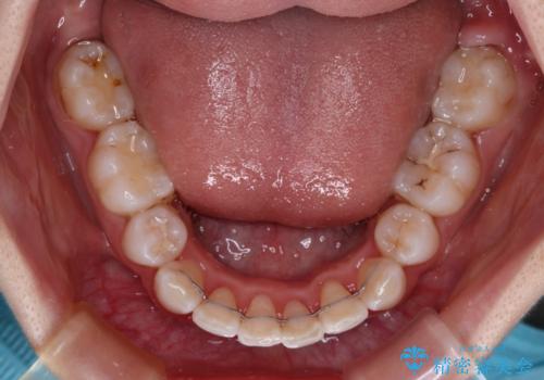 叢生・ディープバイト・突出 ワイヤー装置での抜歯矯正で全てを解決の治療後