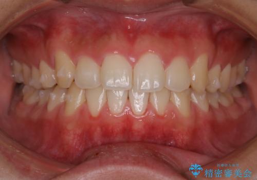 インビザライン矯正 過去に矯正治療したが、また前歯にがたつきがでてきて治したいの治療中