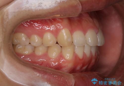 インビザライン矯正 過去に矯正治療したが、また前歯にがたつきがでてきて治したいの治療中