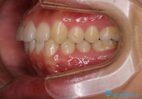 インビザライン矯正 過去に矯正治療したが、また前歯にがたつきがでてきて治したいの治療中
