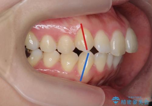 マイクロインプラントで達成する出っ歯の後方移動の症例 治療前
