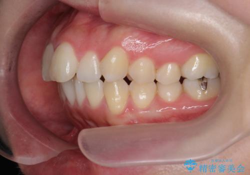 マイクロインプラントで達成する出っ歯の後方移動の治療前