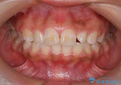 マウスピース矯正で前歯のガタツキを改善! ワイヤー矯正併用でかみ合わせもしっかり治しますの症例 治療前