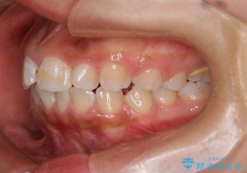 マウスピース矯正で前歯のガタツキを改善! ワイヤー矯正併用でかみ合わせもしっかり治しますの治療前