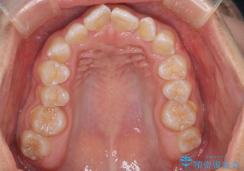 マウスピース矯正で前歯のガタツキを改善! ワイヤー矯正併用でかみ合わせもしっかり治しますの治療前