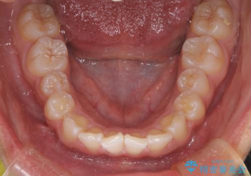 マウスピース矯正で前歯のガタツキを改善! ワイヤー矯正併用でかみ合わせもしっかり治しますの治療前