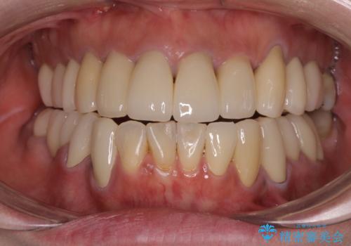 治療を開始したもののうまく噛めない 咬合改善のオールセラミック補綴治療の症例 治療後