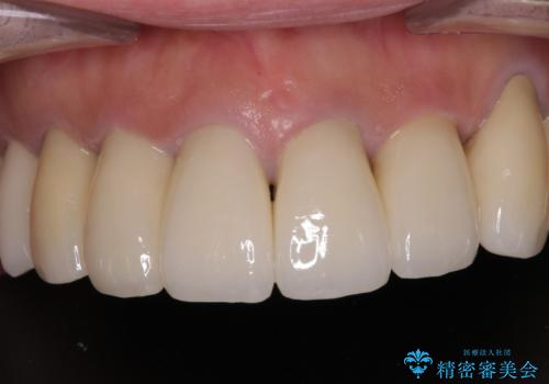 治療を開始したもののうまく噛めない 咬合改善のオールセラミック補綴治療の治療後