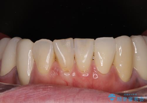 治療を開始したもののうまく噛めない 咬合改善のオールセラミック補綴治療の治療後