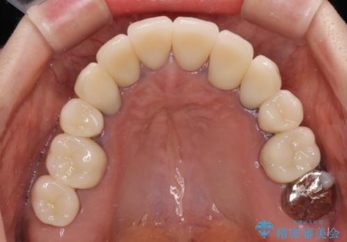 治療を開始したもののうまく噛めない 咬合改善のオールセラミック補綴治療の治療後