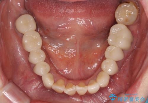 治療を開始したもののうまく噛めない 咬合改善のオールセラミック補綴治療の治療後