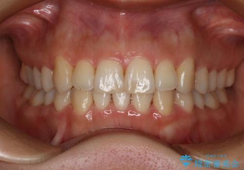 インビザライン矯正　短期間でがたつきのないきれいな歯並びにの症例 治療後