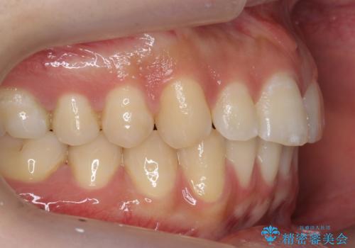 すきっ歯 セラミックで治すか矯正で治すか相談したいの治療前